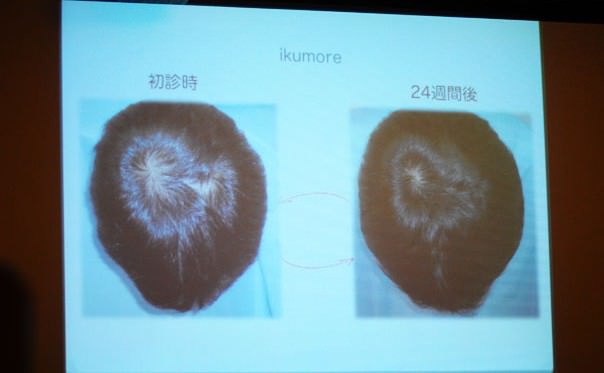 育毛プログラムの結果 育毛プログラムの結果